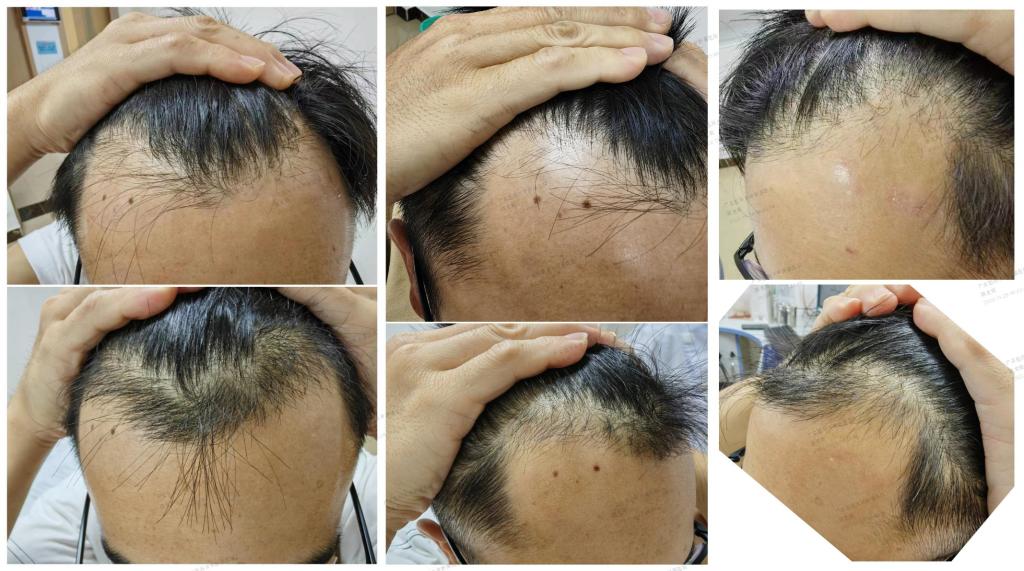 上图为治疗前，下图为PRP治疗2次后头发改善情况